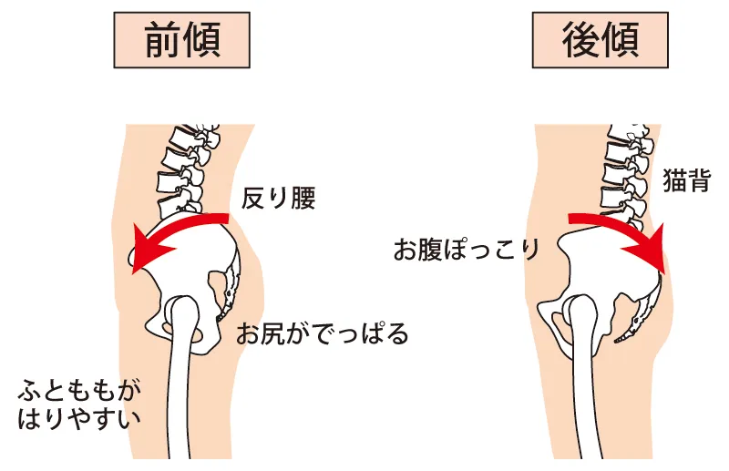 骨盤のゆがみ